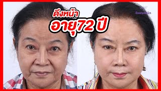 ลูกตกใจทำไมหน้าเด็ก อายุ72ปี มาดึงหน้าที่ธีรพร รีวิว 3 เดือน ธีรพรคลินิก หมอชลธิศ