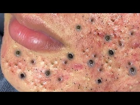 Another Huge Back Blackhead Squeeze New Video - YouTube