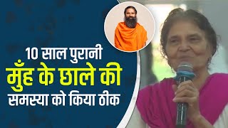 10 साल पुरानी मुँह के छाले की समस्या को किया ठीक || Swami Ramdev