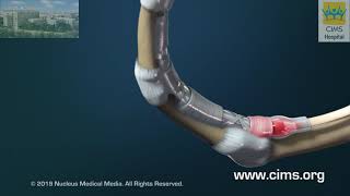 Trigger Finger Stenosing Tenosynovitis – CIMS Hospital