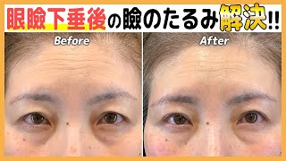 2回手術が必要？眼瞼下垂後に眉下リフトで理想のスッキリ目元に！【眼瞼下垂＋眉下リフト】