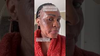 Chemical peel, day 1 to 7 , skin Resurfacing #foryou #shorts #shortvideo