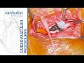 Aortic, Popliteal Thrombectomy, Dorsalis Pedis Exposure (Alan B. Lumsden, MD, Ross McFall, MD)