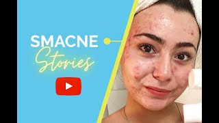 SMACNE Stories: Day 30 - Aida Kihal shares her SMACNE results!