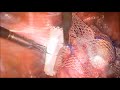 Laparoscopic lateral suspension for advanced pelvic organ prolapse