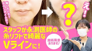 【施術中の様子あり】スタッフが永渕医師の糸リフトで綺麗なVラインに！【小顔・たるみ解消もSBC松山院へ】