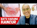 3 Cara Hancurkan Batu Karang Hempedu Dalam Masa 3 Hari