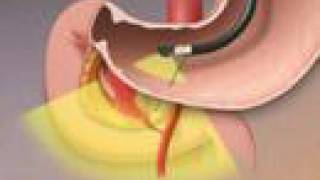 Treating GI Bleed-Mayo Clinic
