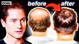 Bryan Johnson Reveals How He Reverses Hair Loss!