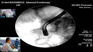 ERCP  for pancreatic stones