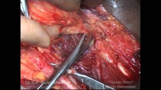 Groin Block Dissection