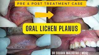 ORAL LICHEN PLANUS, ORAL LICHEN PLANUS TREAMENT, LICHEN PLANUS PRE AND POST, #ORALLICHENPLANUS