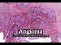 How Does Angioma Look? | What is Angioma? | How to Say Angioma in English?