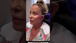 ICONIC FACELIFT Healing & Recovery Process!