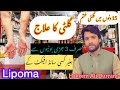 Lipoma Ka ilaj | #Lipoma kya hai | #Gilti ka ilaj kese kiya jay | Lipoma kein Details | گلٹی کا علاج