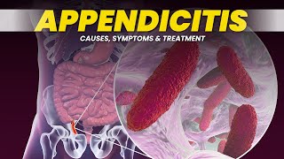 Understanding Appendicitis: Causes, Symptoms and Treatment | 3D Animation