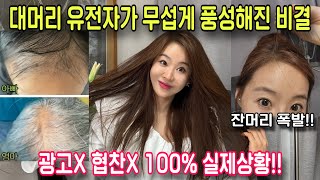 찐 탈모인이 유전탈모 극복하고 무섭게 머리숱 많아진 2가지 방법/머리숱 많아지는법 & 머리카락 굵어지는 법