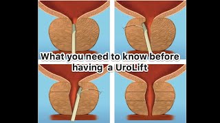 What you need to know before a UroLift procedure for the treatment of benign prostatic enlargement