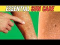 Prevent and Treat Solar Leucoderma: Essential Care for Sun-Exposed Skin