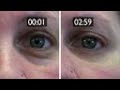 How To Get Rid Of Wrinkles And Eye Bags Without Surgery W/Plexaderm