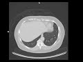 How CT scans work (Houndsfield units)