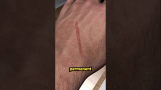 How Do Scars Form and Heal