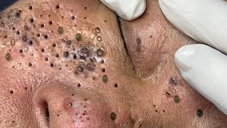 Big Cystic Acne Blackheads Extraction Blackheads \u0026 Milia, Whiteheads Removal Pimple Popping # 1426