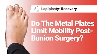 Do The Metal Plates Limit Mobility Post-Bunion Surgery? | Lapiplasty® Recovery