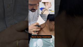 Chiropractic treatment for neck hump #trend #feed #ytshortsfeed