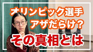 吸い玉のすごい効果と注意点とは！バドミントンの奥原選手を魅了する技術【漢方養生指導士が教える】