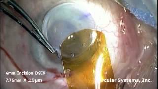 EndoSerter® Live Surgical Demonstration Video - Case #1