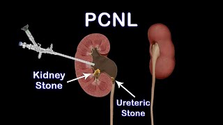 PCNL explained in Hindi I Kidney Stone Relief: Understanding PCNL Surgery and its Benefits