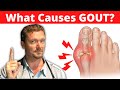 What Causes GOUT? (Meat Doesn't Cause Gout) 2024