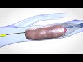 Blood Clot Removal Device - Medical  Scientific Video Production