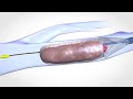 Blood Clot Removal Device - Medical & Scientific Video Production