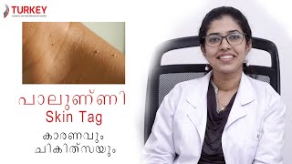 How to Remove Skin Tags - പാലുണ്ണി (അരിമ്പാറ) മാറ്റം - Dr. Nikhila - Turkey Cosmetic Clinic