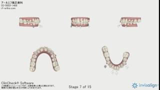 症例10 マウスピース矯正・インビザライン 叢生症例 クリンチェック