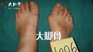 什麼叫做大腳骨，Bunion 拇外翻是怎麼回事？hallux valgus