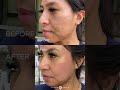 #shorts ACNE SCAR COMBINATION | HYBRID LASER + CO2 ABLATIVE | Dr. Jason Emer