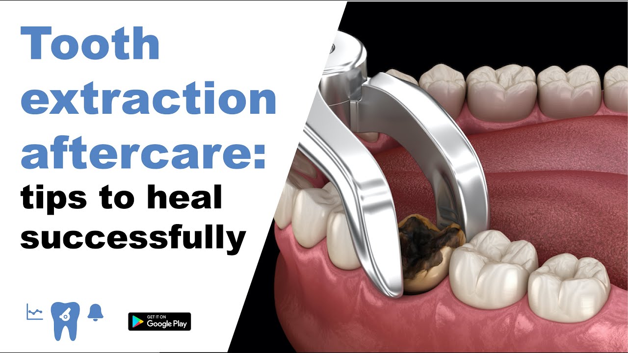 Tooth Extraction Aftercare: Tips To Heal Successfully. - YouTube