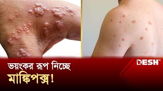 সংক্রমণ দ্রুত ঠেকানোর তাগিদ বিশেষজ্ঞদের | Monkey Pox | News | Desh TV