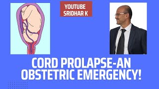 Cord prolapse during labour-what does it mean? #cordprolapse #emergency