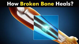 Process of Bone Healing | Bone Healing Steps (Urdu/Hindi)