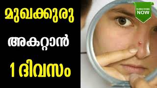 മുഖക്കുരു മാറാൻ 1 ദിവസം |Home remedies for pimples in Malayalam.