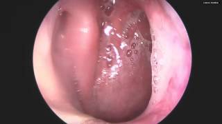 Nasal Endoscopy Sinusitis