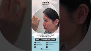 Incisional Double Eyelid and Dual Canthoplasty | Sketch Plastic Surgery