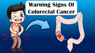 Warning Signs Of Colon Cancer - What Are The Early Signs & Symptoms Of Colon Cancer?