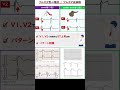 聞き流し1分心電図【ブルガダ症候群】