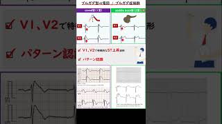 聞き流し1分心電図【ブルガダ症候群】