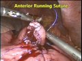 gastro jejunal anastomosis advanced gastric tumor